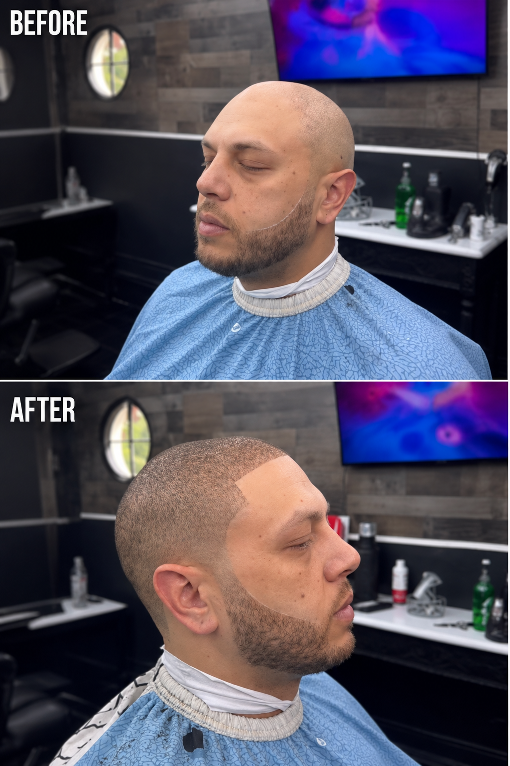 Hair fibre product applied over a close-shaved scalp, the front line shaped with a razor and trimmer, and the edge finished sharp.